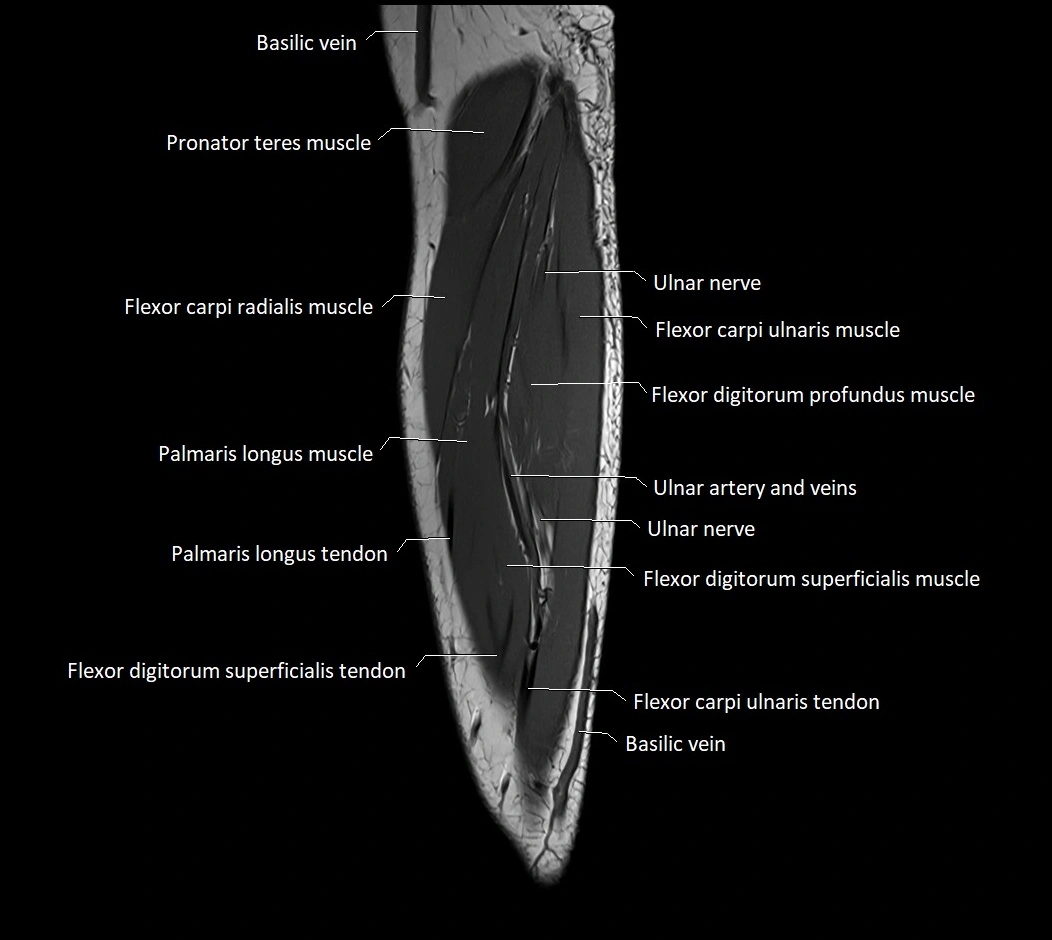 MRI 3T forearm sagittal labelled cross sectional anatomy image 33.webp